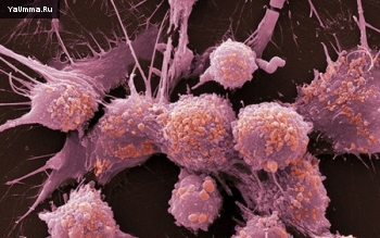 Человек и его здоровье: Как вылечить рак на последней стадии?